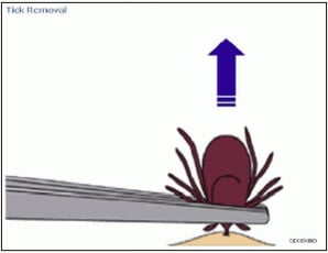 tick_removal